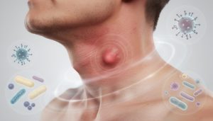 découvrez les principales causes et symptômes d'un ganglion dans le cou pour mieux comprendre cette manifestation et savoir quand consulter un professionnel de santé.